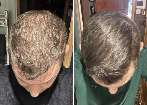 Exosomes Hair Growth Serum with Brush