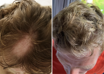 Exosomes Hair Growth Serum with Brush