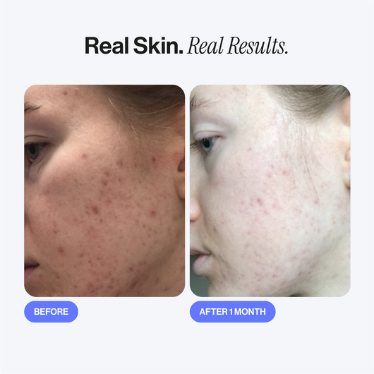 Microneedling Infusion Kit