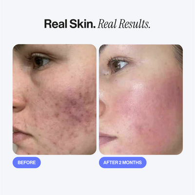 Microneedling Infusion Kit