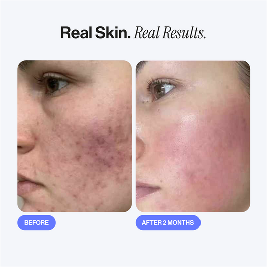 Microneedling Infusion Kit