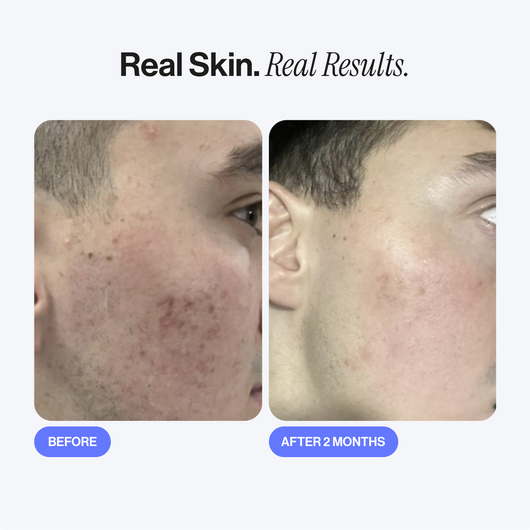 Microneedling Infusion Kit