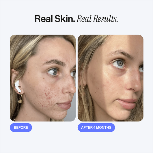 Microneedling Infusion Kit