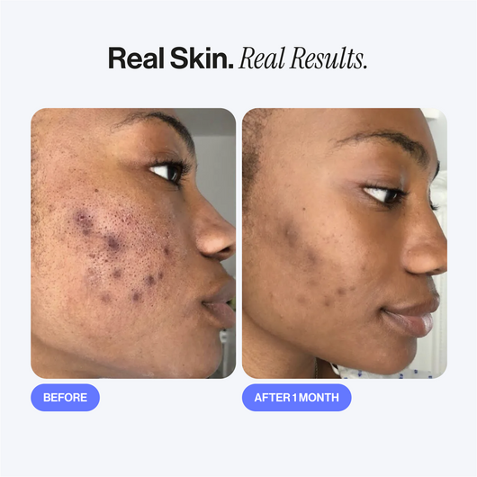 Microneedling Infusion Kit