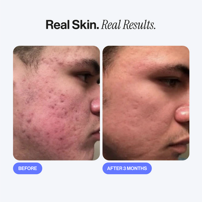 Microneedling Infusion Kit