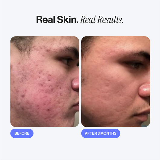 Microneedling Infusion Kit