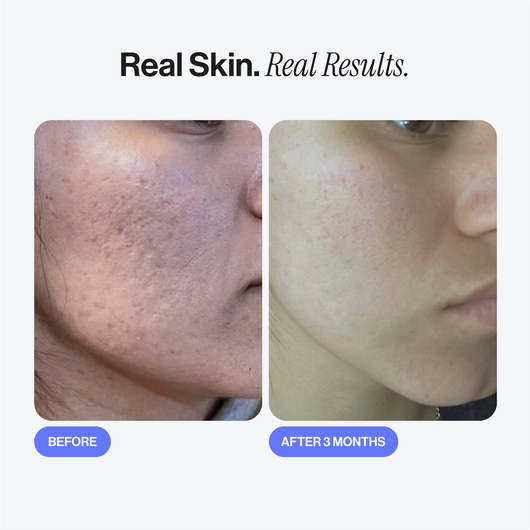 Microneedling Infusion Kit