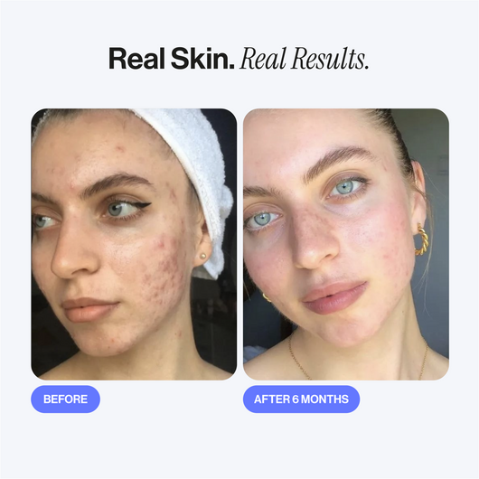 Microneedling Infusion Kit