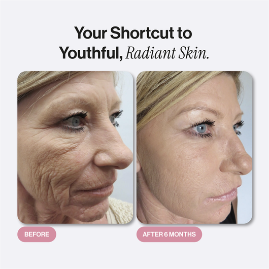 Microneedling Infusion Kit