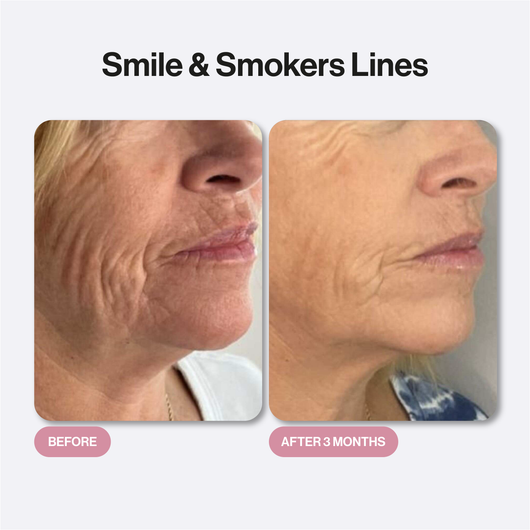 Microneedling Infusion Kit