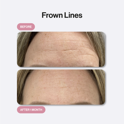 Microneedling Infusion Kit